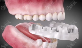 种植牙视频,从术前准备到术后护理